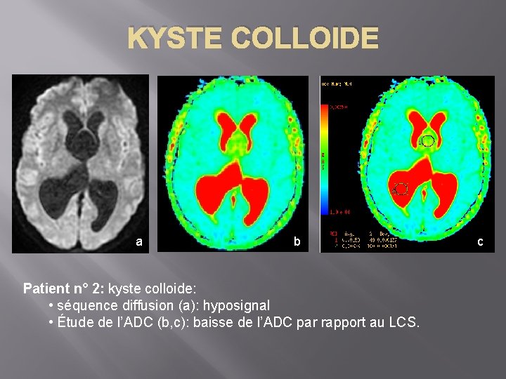 KYSTE COLLOIDE a b Patient n° 2: kyste colloide: • séquence diffusion (a): hyposignal