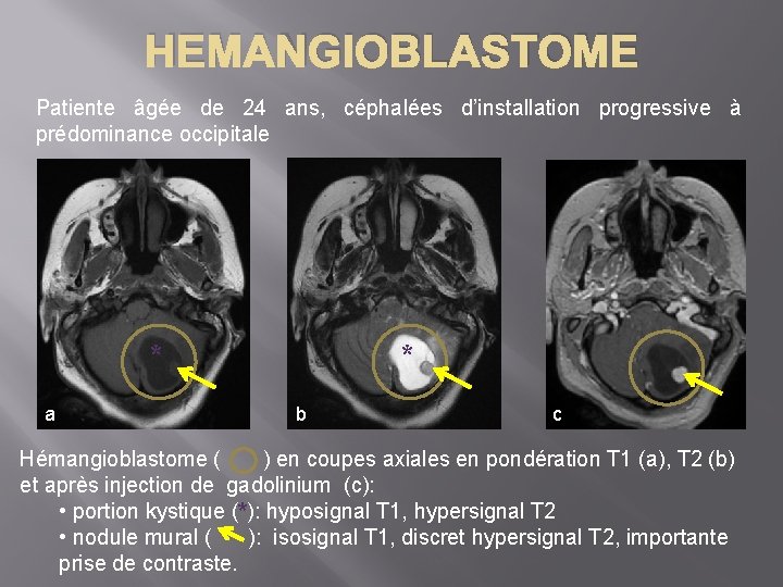 HEMANGIOBLASTOME Patiente âgée de 24 ans, céphalées d’installation progressive à prédominance occipitale * a