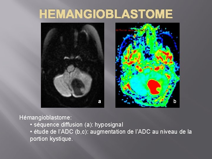 HEMANGIOBLASTOME a b Hémangioblastome: • séquence diffusion (a): hyposignal • étude de l’ADC (b,