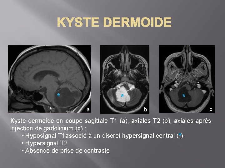 KYSTE DERMOIDE * * a * b c Kyste dermoide en coupe sagittale T