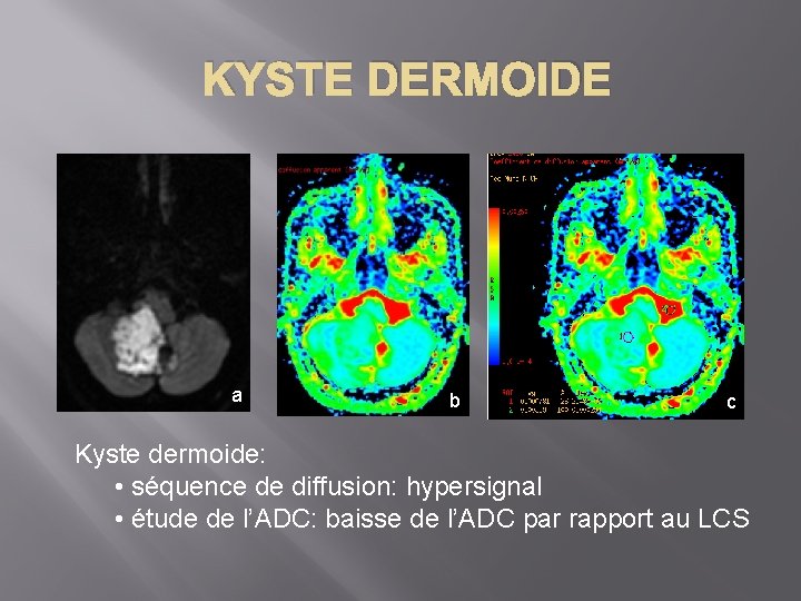 KYSTE DERMOIDE a b c Kyste dermoide: • séquence de diffusion: hypersignal • étude