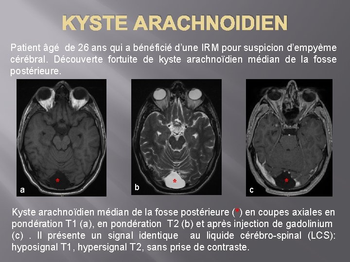 KYSTE ARACHNOIDIEN Patient âgé de 26 ans qui a bénéficié d’une IRM pour suspicion