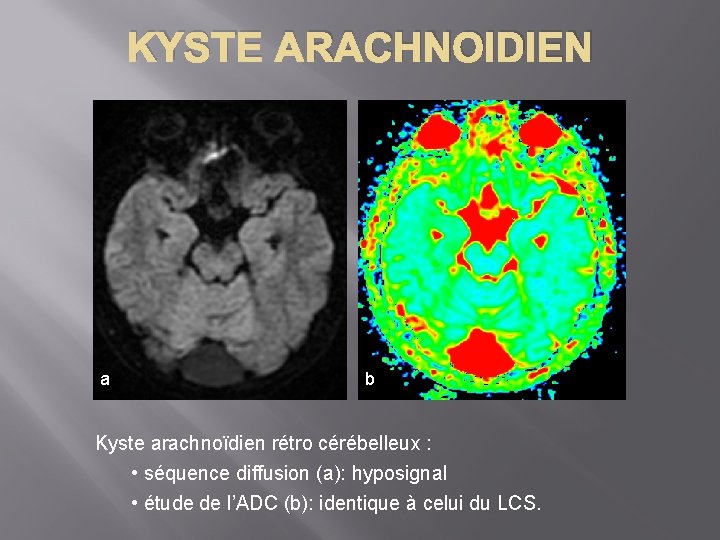 KYSTE ARACHNOIDIEN a a b Kyste arachnoïdien rétro cérébelleux : • séquence diffusion (a):