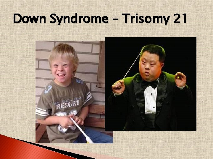 Down Syndrome – Trisomy 21 