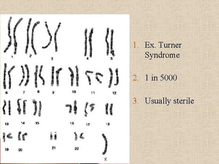1. Ex. Turner Syndrome 2. 1 in 5000 3. Usually sterile 