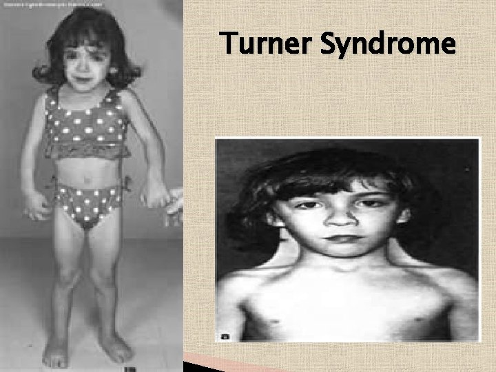 Turner Syndrome 