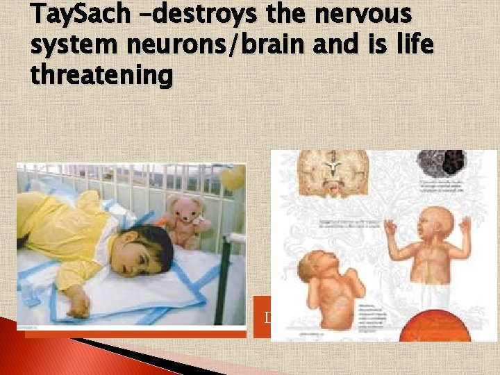 Tay. Sach –destroys the nervous system neurons/brain and is life threatening Destroys brain function