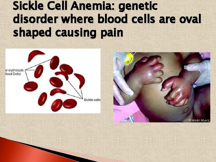 Sickle Cell Anemia: genetic disorder where blood cells are oval shaped causing pain 