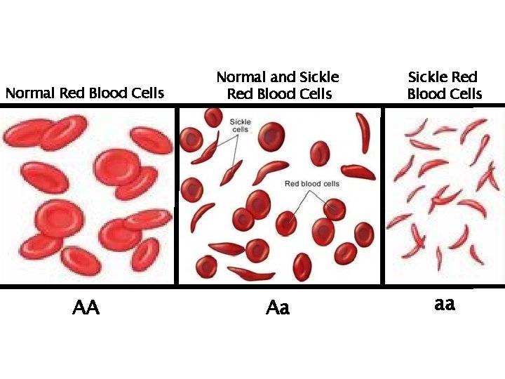 Normal Red Blood Cells Normal and Sickle Red Blood Cells AA Aa aa 