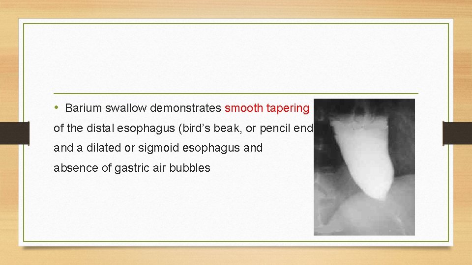 • Barium swallow demonstrates smooth tapering of the distal esophagus (bird’s beak, or • Barium swallow demonstrates smooth tapering of the distal esophagus (bird’s beak, or