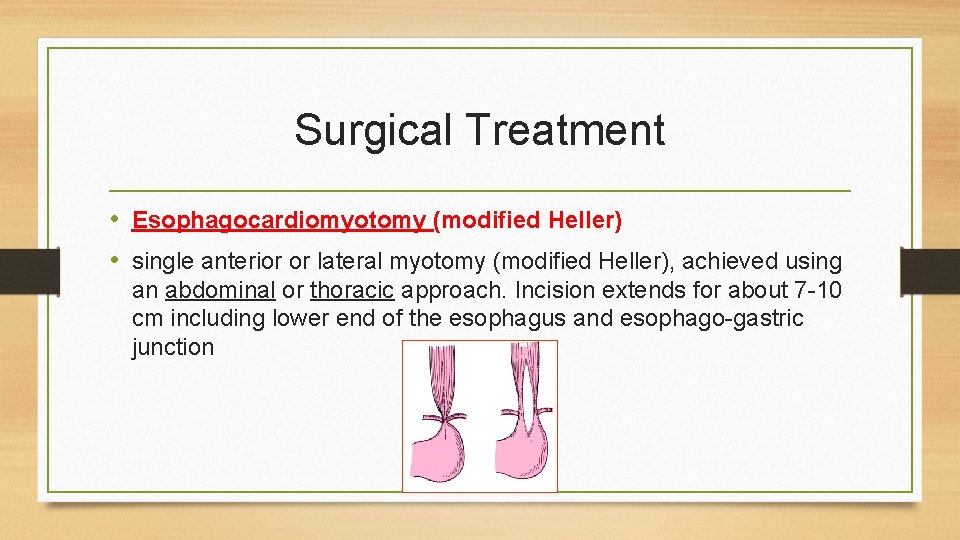 Surgical Treatment • Esophagocardiomyotomy (modified Heller) • single anterior or lateral myotomy (modified Heller), Surgical Treatment • Esophagocardiomyotomy (modified Heller) • single anterior or lateral myotomy (modified Heller),