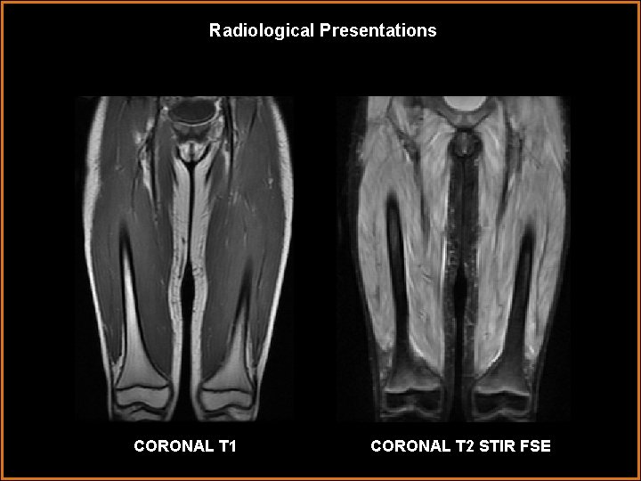 Radiological Presentations CORONAL T 1 CORONAL T 2 STIR FSE 