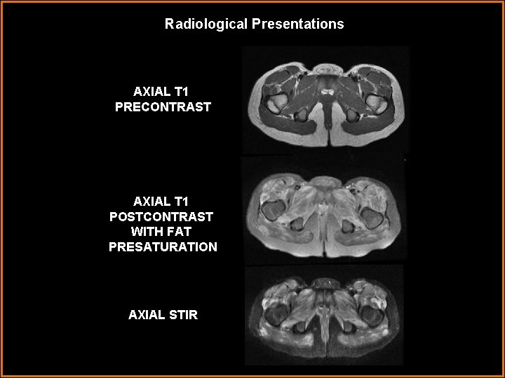 Radiological Presentations AXIAL T 1 PRECONTRAST AXIAL T 1 POSTCONTRAST WITH FAT PRESATURATION AXIAL
