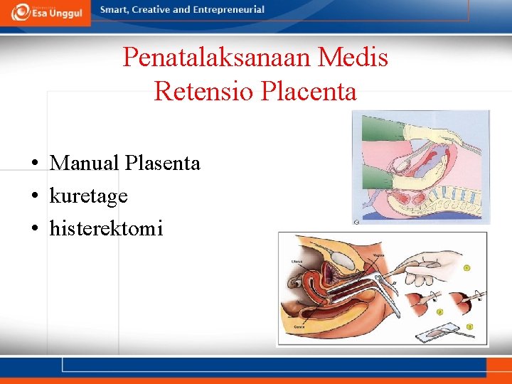 Penatalaksanaan Medis Retensio Placenta • Manual Plasenta • kuretage • histerektomi 