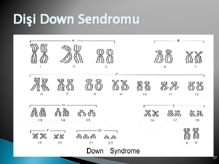 Dişi Down Sendromu 2 n = 47 37 