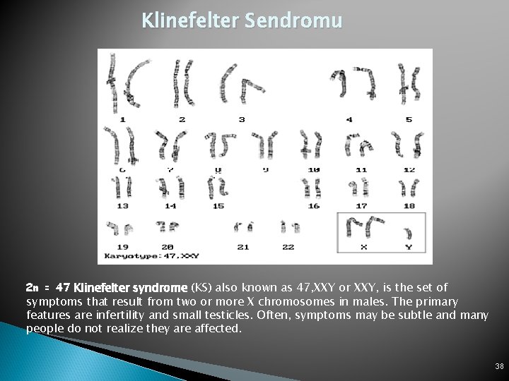 Klinefelter Sendromu 2 n = 47 Klinefelter syndrome (KS) also known as 47, XXY