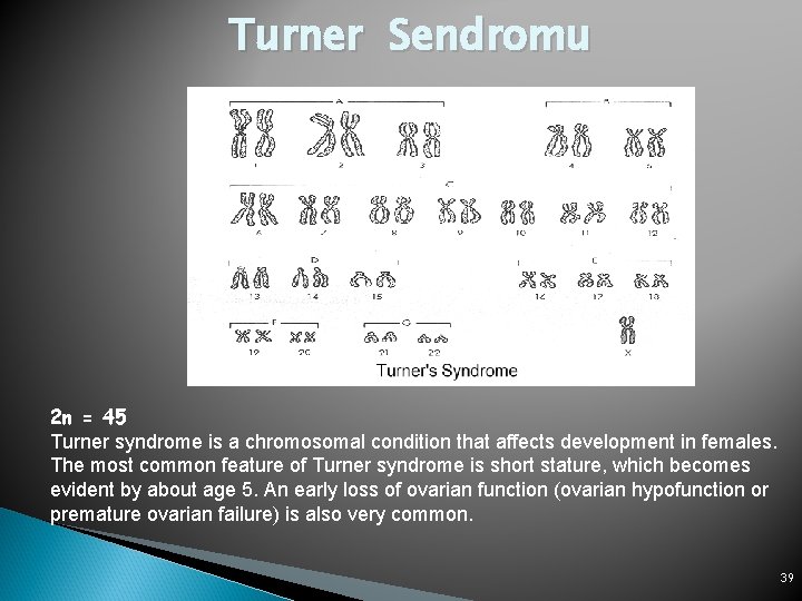 Turner Sendromu 2 n = 45 Turner syndrome is a chromosomal condition that affects