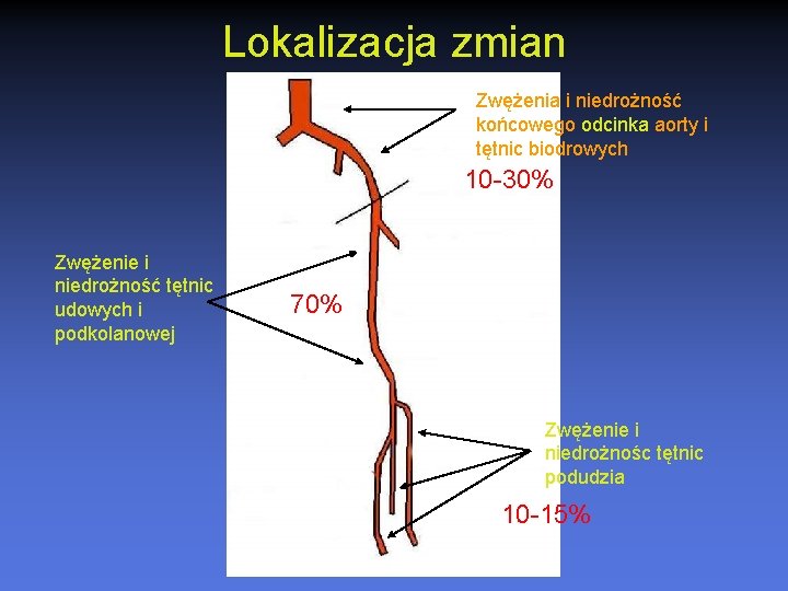 Lokalizacja zmian Zwężenia i niedrożność końcowego odcinka aorty i tętnic biodrowych 10 -30% Zwężenie