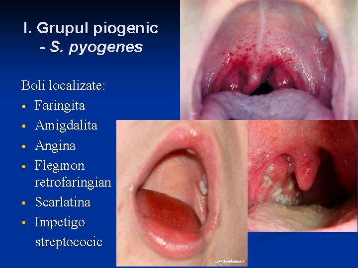 I. Grupul piogenic - S. pyogenes Boli localizate: § Faringita § Amigdalita § Angina I. Grupul piogenic - S. pyogenes Boli localizate: § Faringita § Amigdalita § Angina