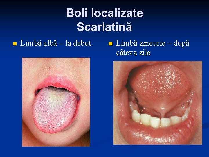 Boli localizate Scarlatină n Limbă albă – la debut n Limbă zmeurie – după Boli localizate Scarlatină n Limbă albă – la debut n Limbă zmeurie – după