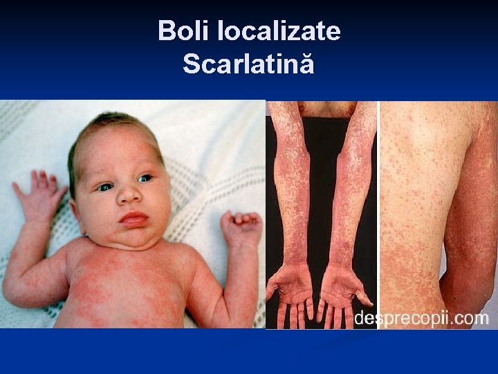 Boli localizate Scarlatină Boli localizate Scarlatină