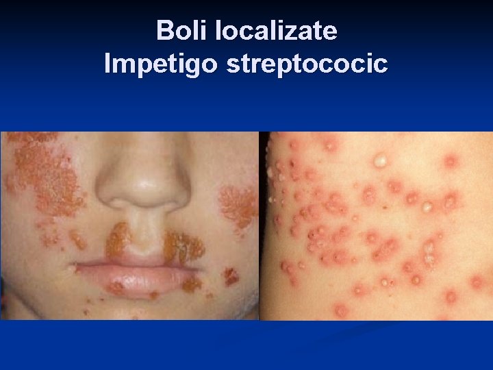 Boli localizate Impetigo streptococic Boli localizate Impetigo streptococic