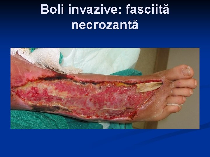 Boli invazive: fasciită necrozantă Boli invazive: fasciită necrozantă