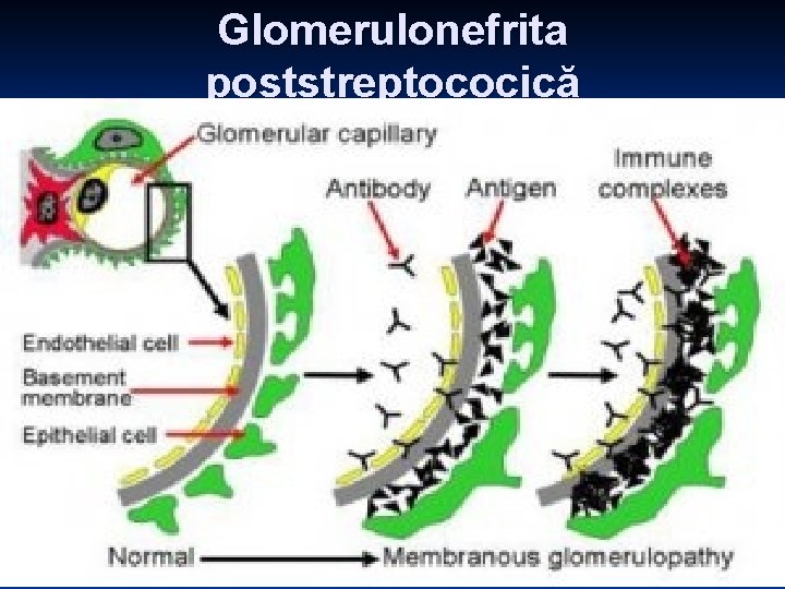 Glomerulonefrita poststreptococică Glomerulonefrita poststreptococică