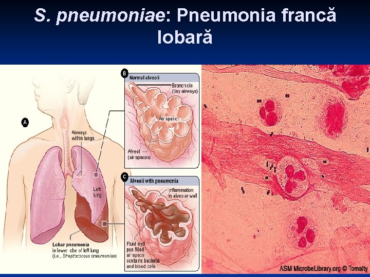 S. pneumoniae: Pneumonia francă lobară S. pneumoniae: Pneumonia francă lobară