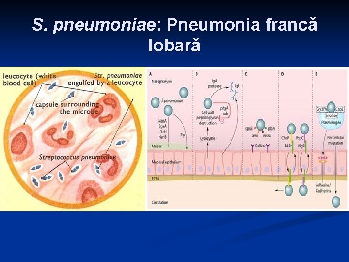 S. pneumoniae: Pneumonia francă lobară S. pneumoniae: Pneumonia francă lobară