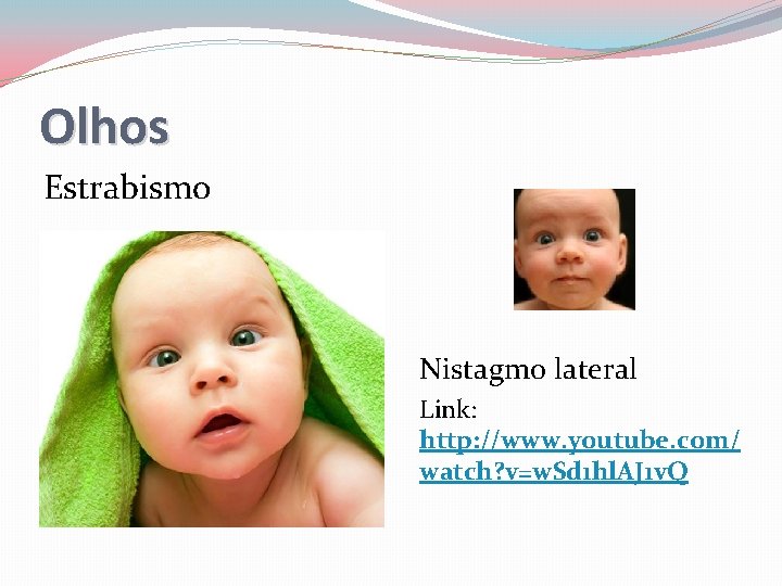 Olhos Estrabismo Nistagmo lateral Link: http: //www. youtube. com/ watch? v=w. Sd 1 hl.