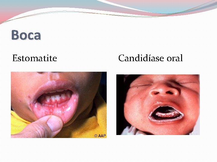 Boca Estomatite Candidíase oral 