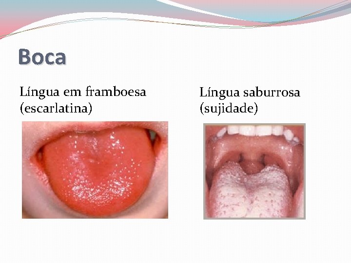 Boca Língua em framboesa (escarlatina) Língua saburrosa (sujidade) 