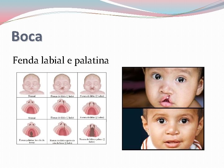 Boca Fenda labial e palatina 