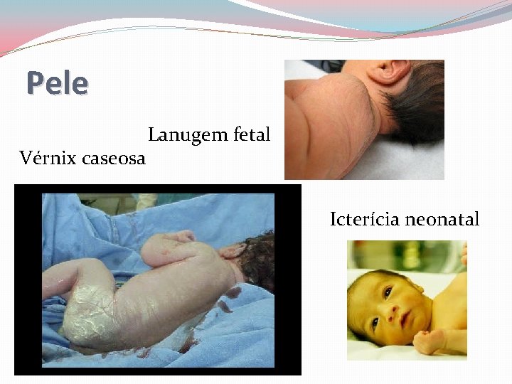 Pele Vérnix caseosa Lanugem fetal Icterícia neonatal 