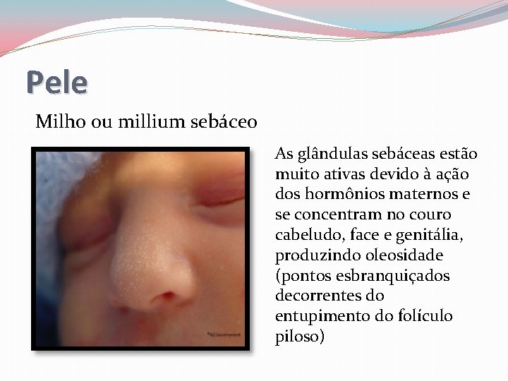 Pele Milho ou millium sebáceo As glândulas sebáceas estão muito ativas devido à ação