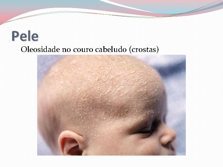 Pele Oleosidade no couro cabeludo (crostas) 