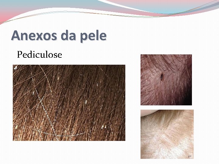 Anexos da pele Pediculose 