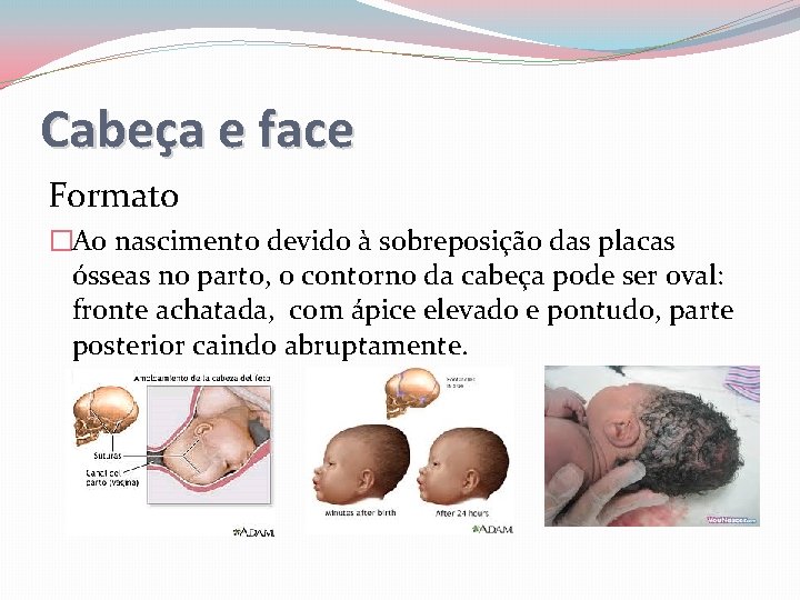 Cabeça e face Formato �Ao nascimento devido à sobreposição das placas ósseas no parto,