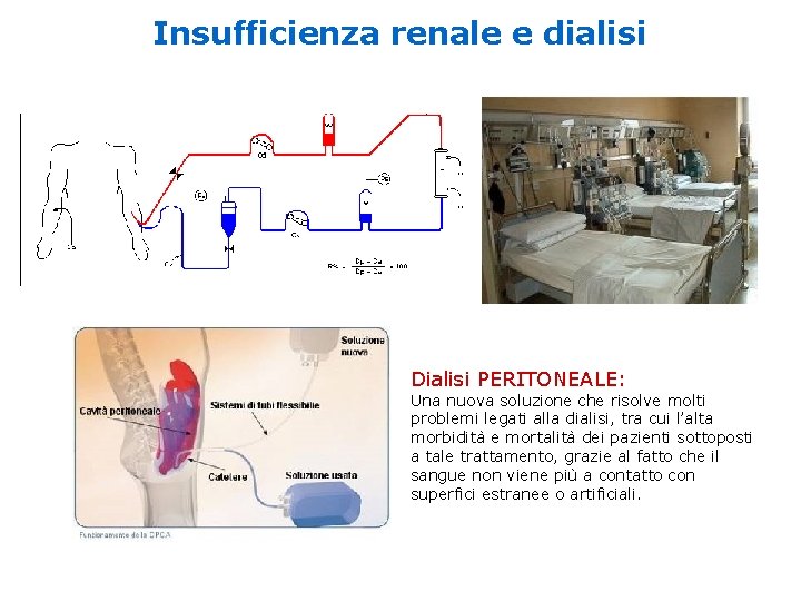Insufficienza renale e dialisi Dialisi PERITONEALE: Una nuova soluzione che risolve molti problemi legati Insufficienza renale e dialisi Dialisi PERITONEALE: Una nuova soluzione che risolve molti problemi legati