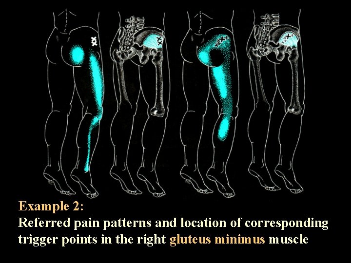 Example 2: Referred pain patterns and location of corresponding trigger points in the right
