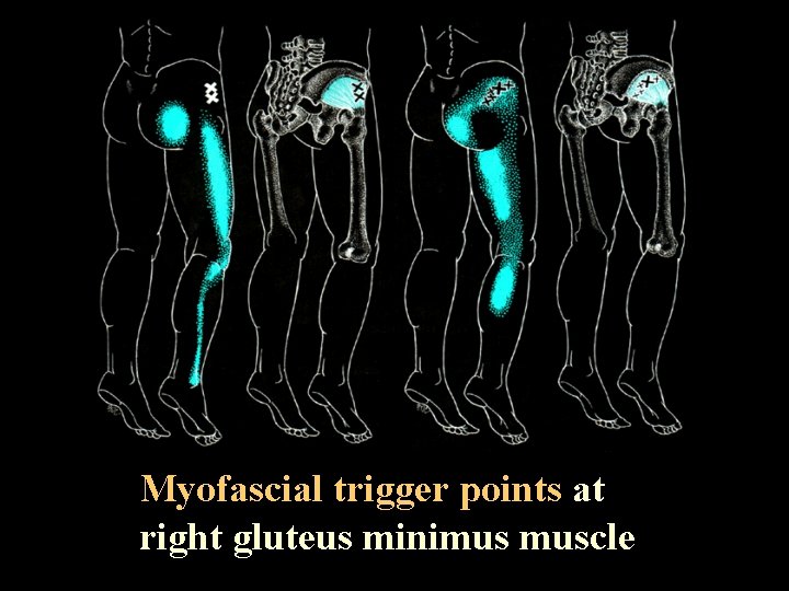 Myofascial trigger points at right gluteus minimus muscle 