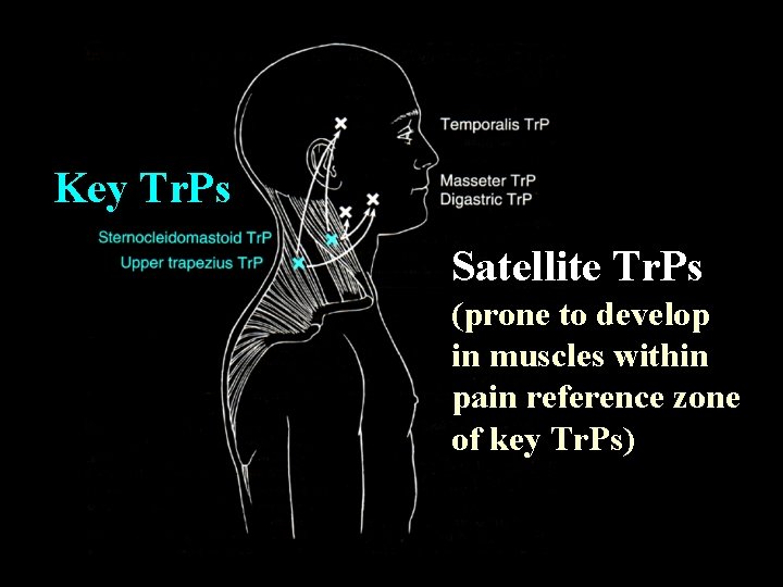 Key Tr. Ps Satellite Tr. Ps (prone to develop in muscles within pain reference