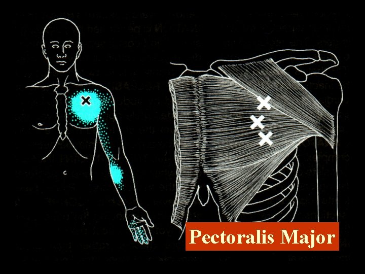 Pectoralis Major 