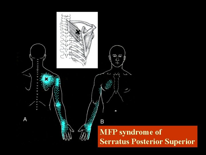 MFP syndrome of Serratus Posterior Superior 