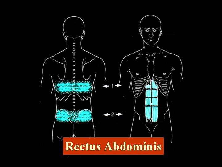 Rectus Abdominis 