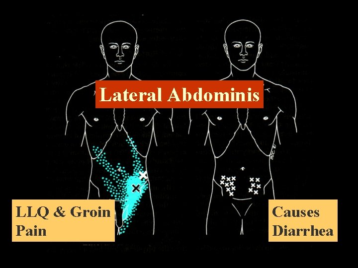 Lateral Abdominis LLQ & Groin Pain Causes Diarrhea 
