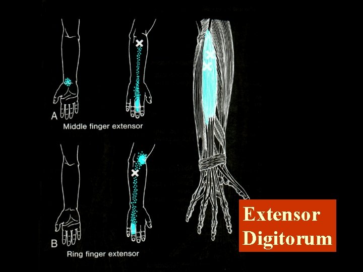 Extensor Digitorum 