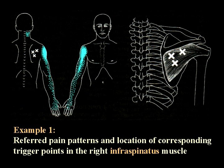 Example 1: Referred pain patterns and location of corresponding trigger points in the right