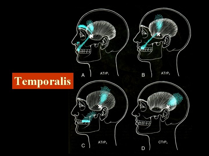 Temporalis 